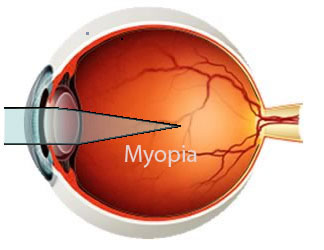 myopia.jpg