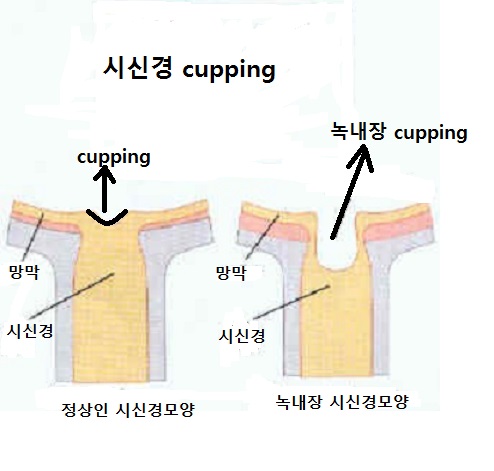 cupping.jpg